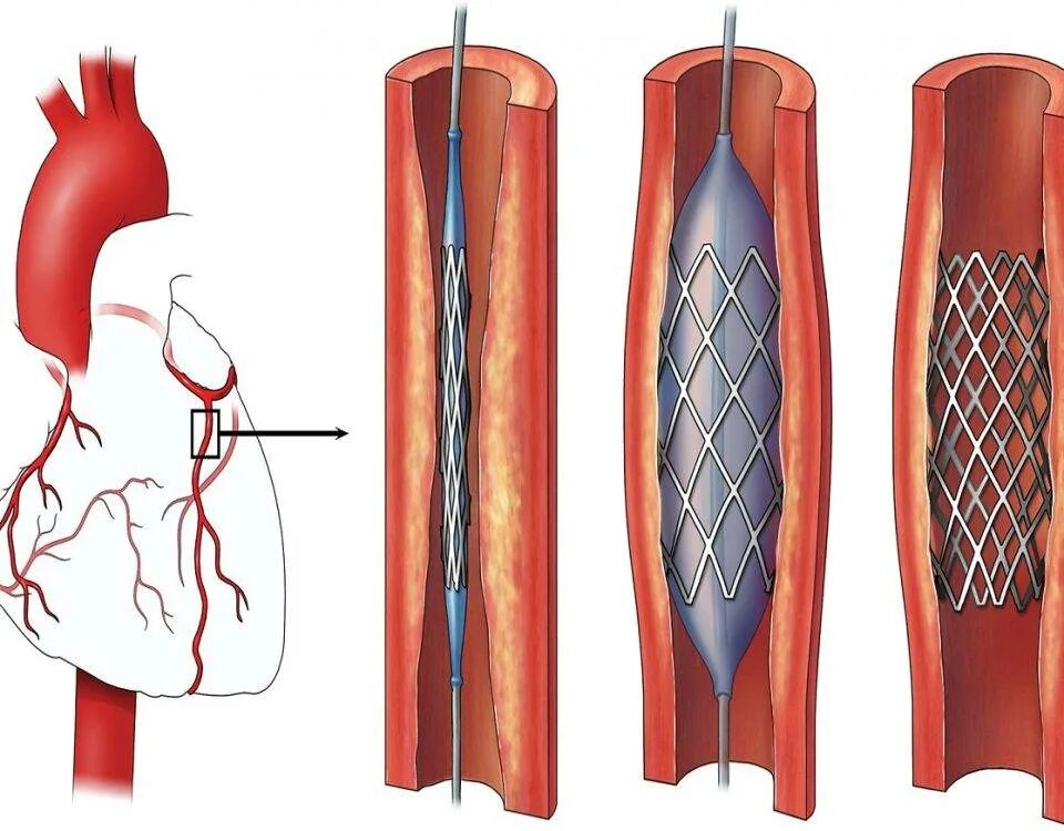 Коронарное стентирование сосудов сердца. ЧКВ баллонная ангиопластика. Баллонная ангиопластика и стентирование артерий сердца. Расширяет коронарные сосуды