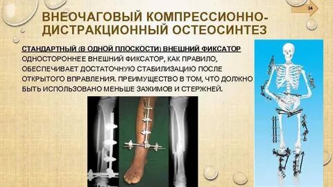 Травматология переломы презентация