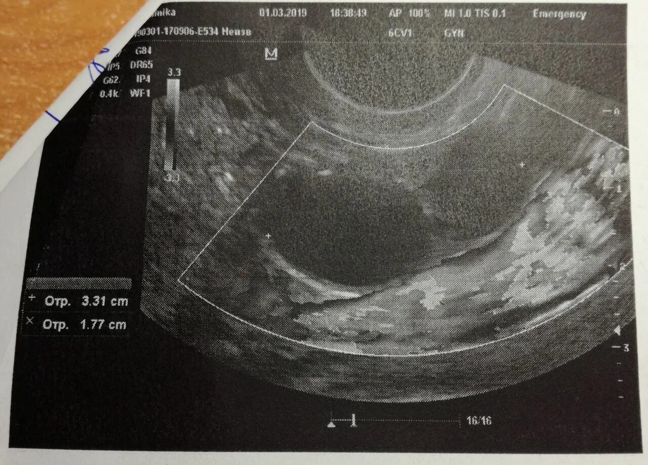 Фолликулы 6 мм. Два доминантных фолликула на УЗИ. Доминантный фолликул на УЗИ.