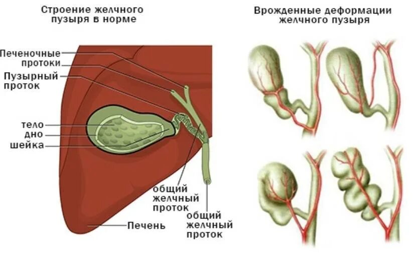 Перегиб желчного пузыря у женщины. S образный перегиб желчного пузыря. дисформия желчного пузыря. жёлчный пузырь патология с загибом. кривой желчный пузырь.