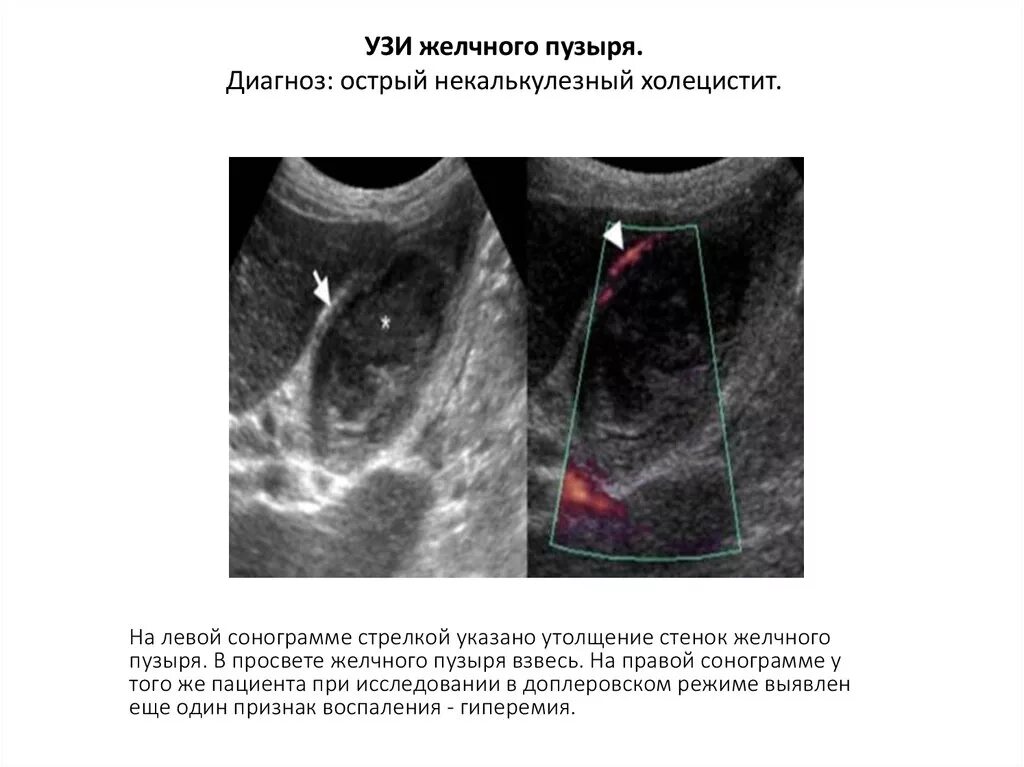 Желчный пузырь протокол. Хронический бескаменный холецистит УЗИ. Хронический калькулезный холецистит УЗИ заключение. Хронический калькулезный холецистит УЗИ. Дисхолия желчного пузыря на УЗИ.