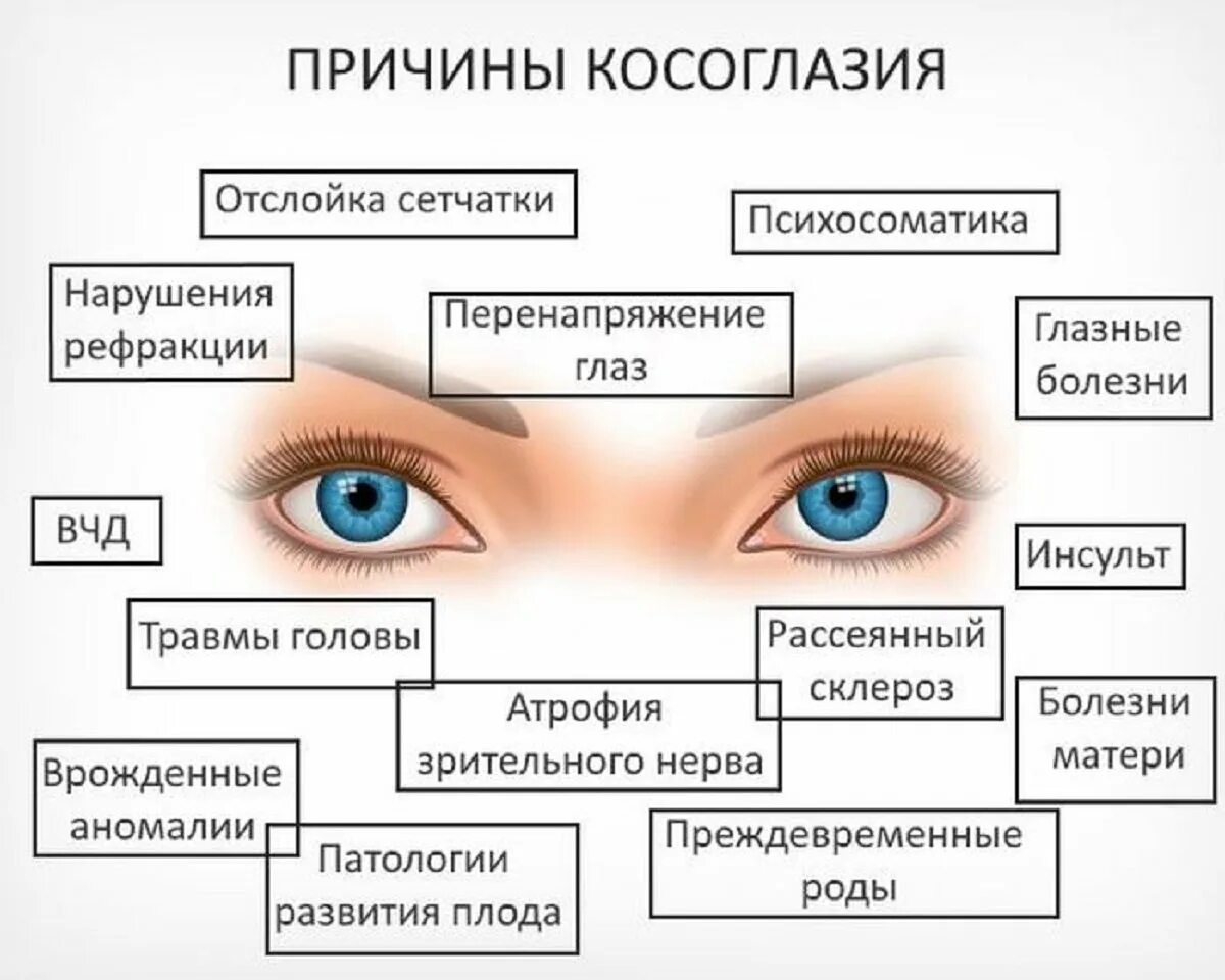 Причины заболевания зрения. Классификация косоглазия офтальмология. Косоглазие причины возникновения. Таблица заболевания глаз косоглазие. Причины появления косоглазия.