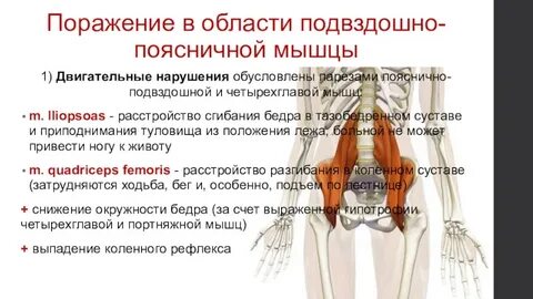 Подвздошный синдром