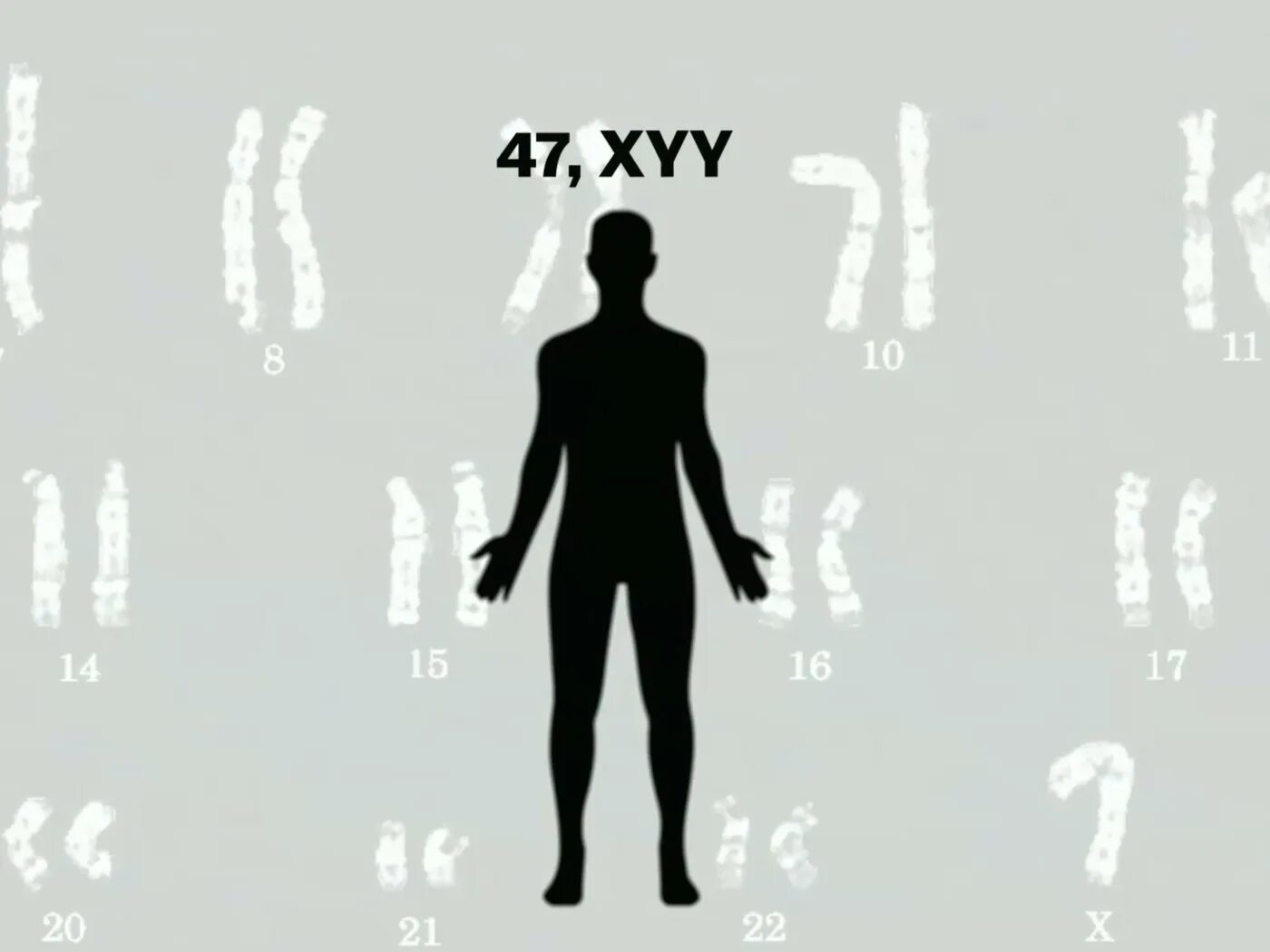 Xxy хромосома. Синдром дисомии по y-хромосоме. XYY хромосомы. XYY хромосомы у мужчин. Дисомия y хромосомы.