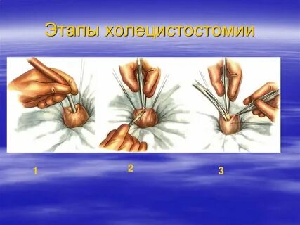 Холецистостома