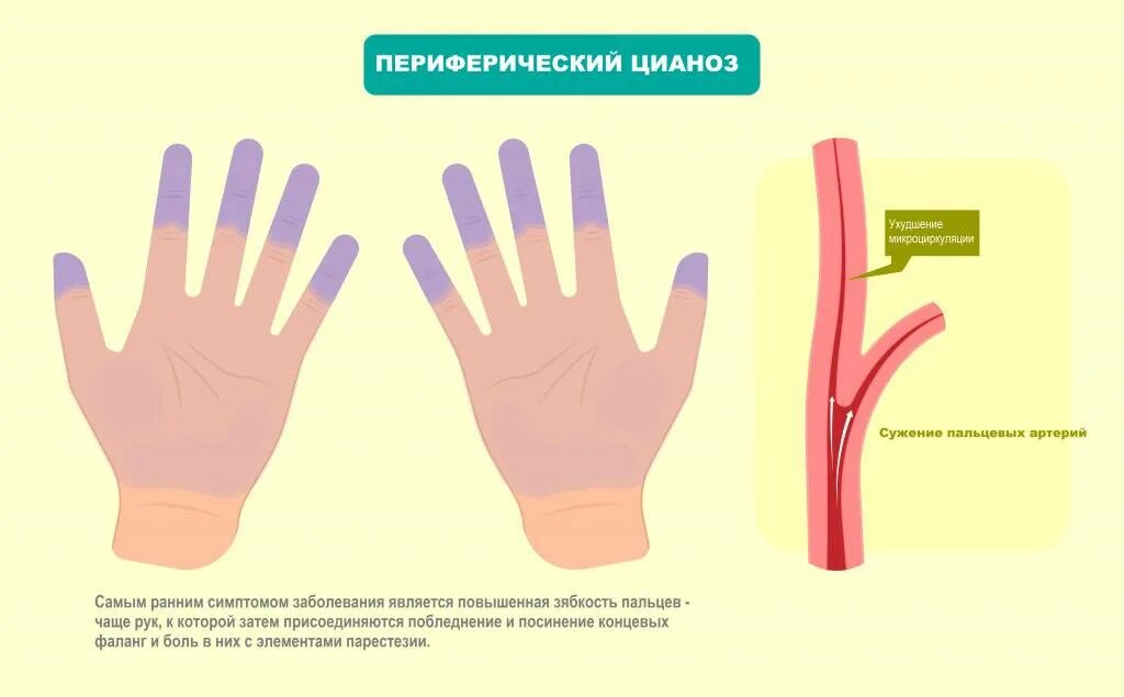 Холодные руки при температуре у ребенка. Синдром перчаток и носков. Синдром Рейно лечебная физкультура. Синдром холодных конечностей.