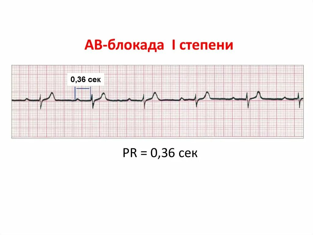 Блокада на первом. Атриовентрикулярная блокада Мобиц 1 ЭКГ. АВ-блокада i степени на ЭКГ. АВ блокада 1 степени на ЭКГ. АВ блокада 1 ст на ЭКГ.