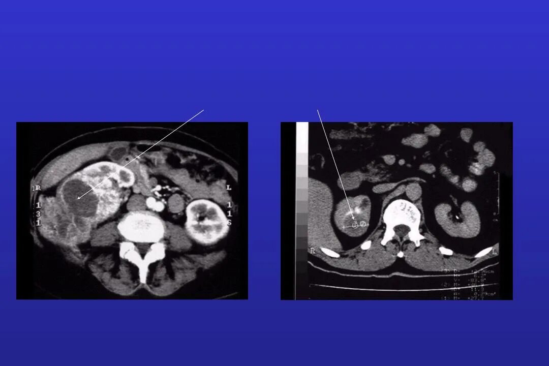 Светлоклеточная карцинома почки кт. Доброкачественные опухоли почки кт. Объемные образования почек кт. Доброкачественное и злокачественное образование