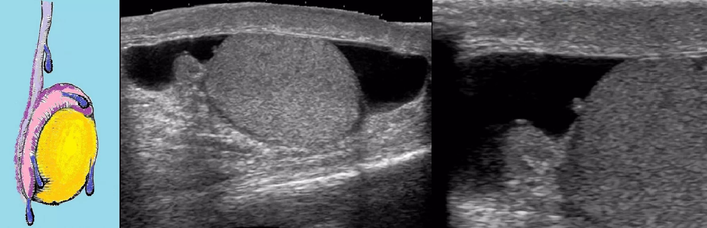Образование придатка яичка. Перекрут гидатиды придатка яичка. Перекрут гидатиды яичка на УЗИ. Гидатида придатка яичка на УЗИ.
