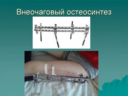 Основы остеосинтеза