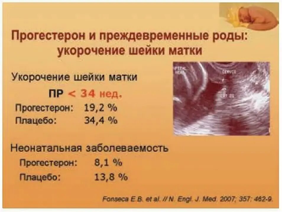 Шейка в 25 недель. Укорочение шейки матки при беременности. Укороченная шейка матки при беременности. Укорочение длины шейки матки.