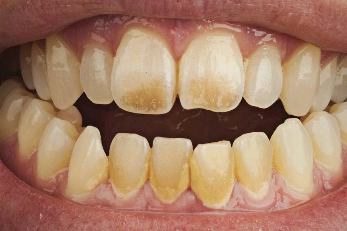 Курить после лечения зуба. Меловидно крапчатый флюороз. Пришеечный пародонтоз.