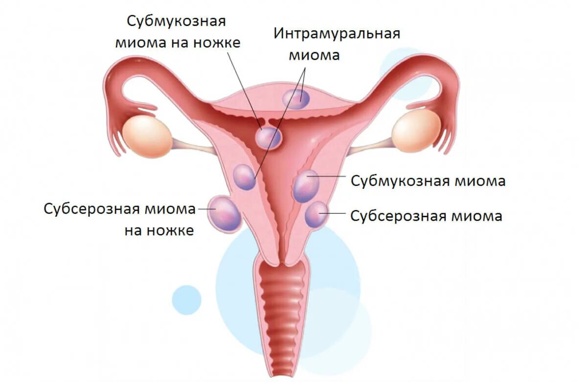 Лейомиома матки что это. Субсерозная миома матки. Интрамурально субмукозная миома матки. Миома матки эхоскопическая. Интрамуральная миома матки что это такое.