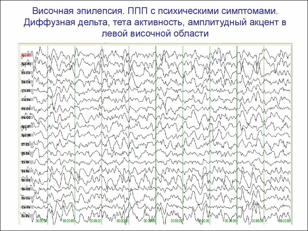 Диффузные эпилептиформные. Электроэнцефалография, норма, ЭЭГ, видеомониторинг ЭЭГ при эпилепсии\. ЭЭГ головного мозга эпилепсии. Эпилептиформная активность на ЭЭГ. ЭЭГ при эпилептическом припадке.