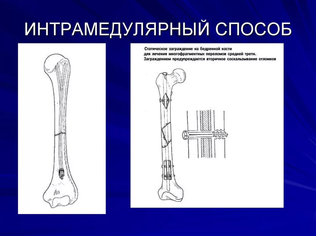 Суставной хрящ функции. Соединение костей строение сустава. Схема развития деформирующего остеоартроза. Функция хряща в суставе. Амортизация костей в суставе.