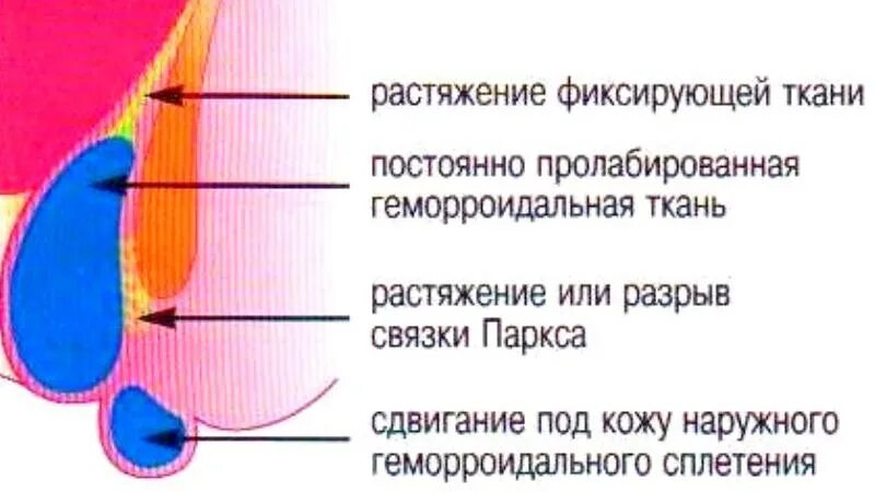 Патогенез геморроидальной болезни. Механизм развития геморроя.