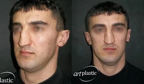 Нос разбор