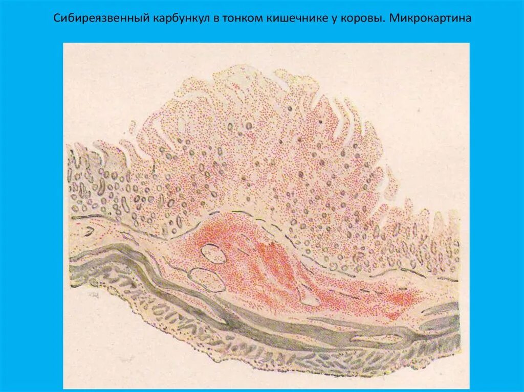 Легочная язва. Сибирская язва карбункул. Сибирская язва кожная карбункул. Сибиреязвенный карбункул в тонком кишечнике у коровы. Сибирско язвенный карбункул.