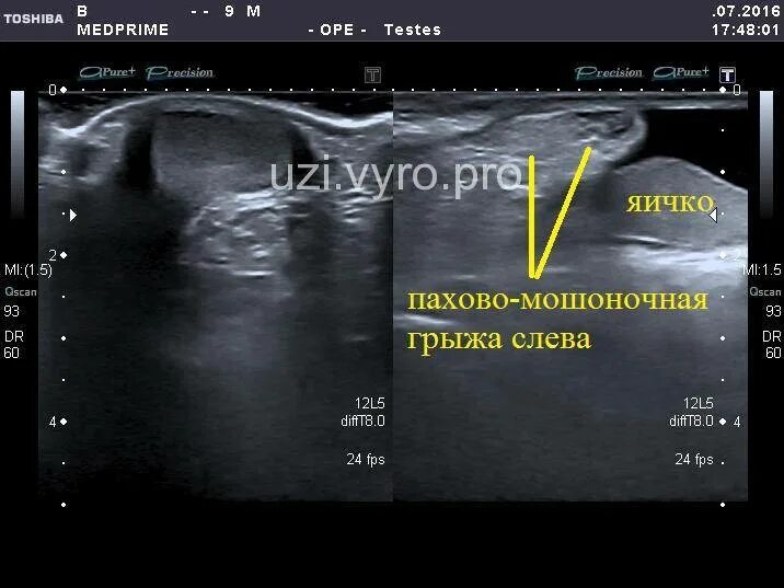 Можно увидеть грыжу на узи. Пахово-мошоночная грыжа на УЗИ протокол. Мошоночная грыжа УЗИ протокол. УЗИ признаки пахово мошоночной грыжи у детей. УЗИ картина паховой грыжи.