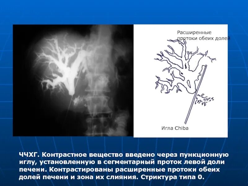 Симптомы забитых желчных протоков. Чрескожная чреспеченочная холангиостомия. Расширение протоков печени. Чрескожная чреспеченочная холангиография. Стриктуры желчных протоков.