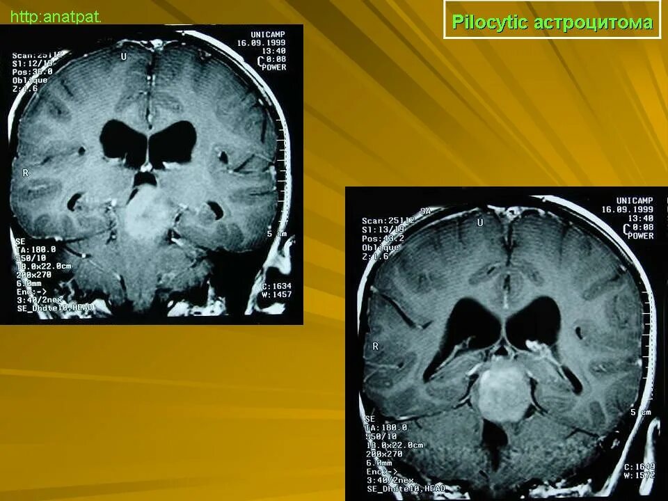 Пилоидная астроцитома. Пилоцитарная астроцитома мрт. Астроцитома головного мозга гистология. Пилоцитарная астроцитома мозжечка кт. Пилоцитарная астроцитома лобной доли.