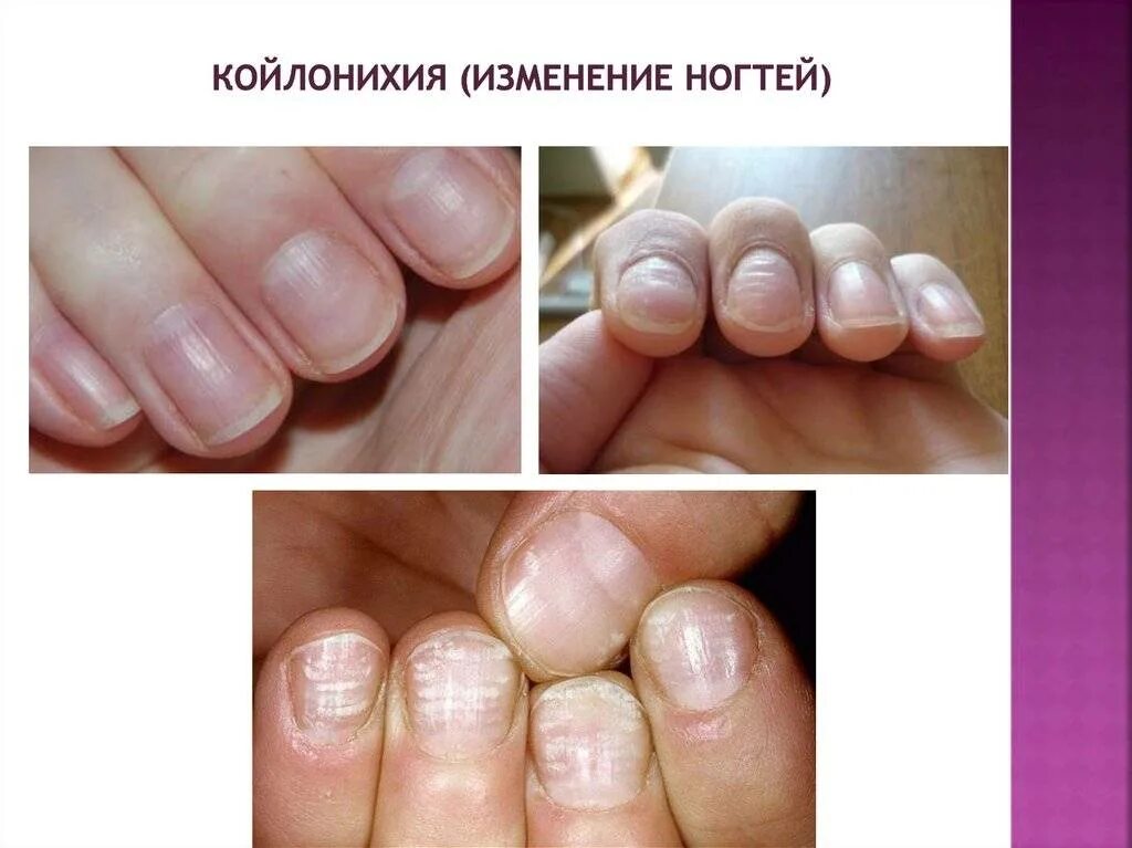 Ногти изменение причина