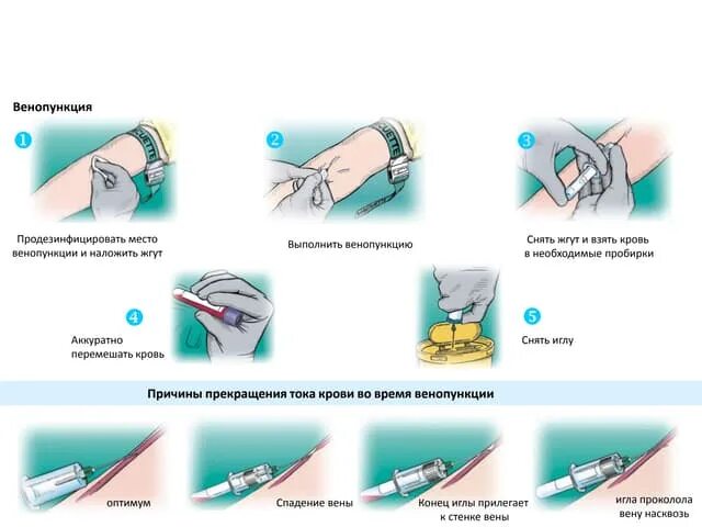 Вакуумный забор крови из вены алгоритм. Система вакутейнер для взятия крови алгоритм действий. Забор крови из периферической вены алгоритм. Взятие венозной крови алгоритм. Забор крови вакутейнером из вены алгоритм.