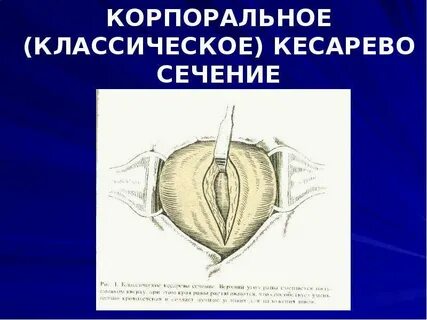 Что такое кесарево сечение у женщин
