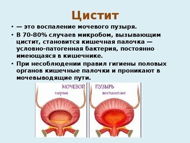 Цистит появление. При воспалении мочевого пузыря. Цистит воспаление мочевого пузыря. Женский цистит.