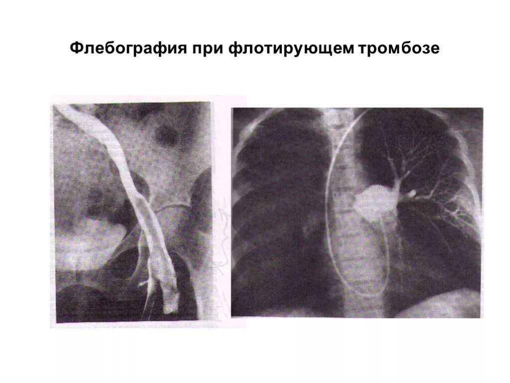 Флотирующий тромб. Флотирующий тромб тэла. флотирующий тромб легочной артерии. флотирующий тромб тэла кт. флотирующий тромб при тэла.