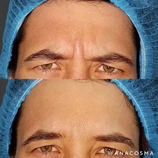 Ботокс ушел