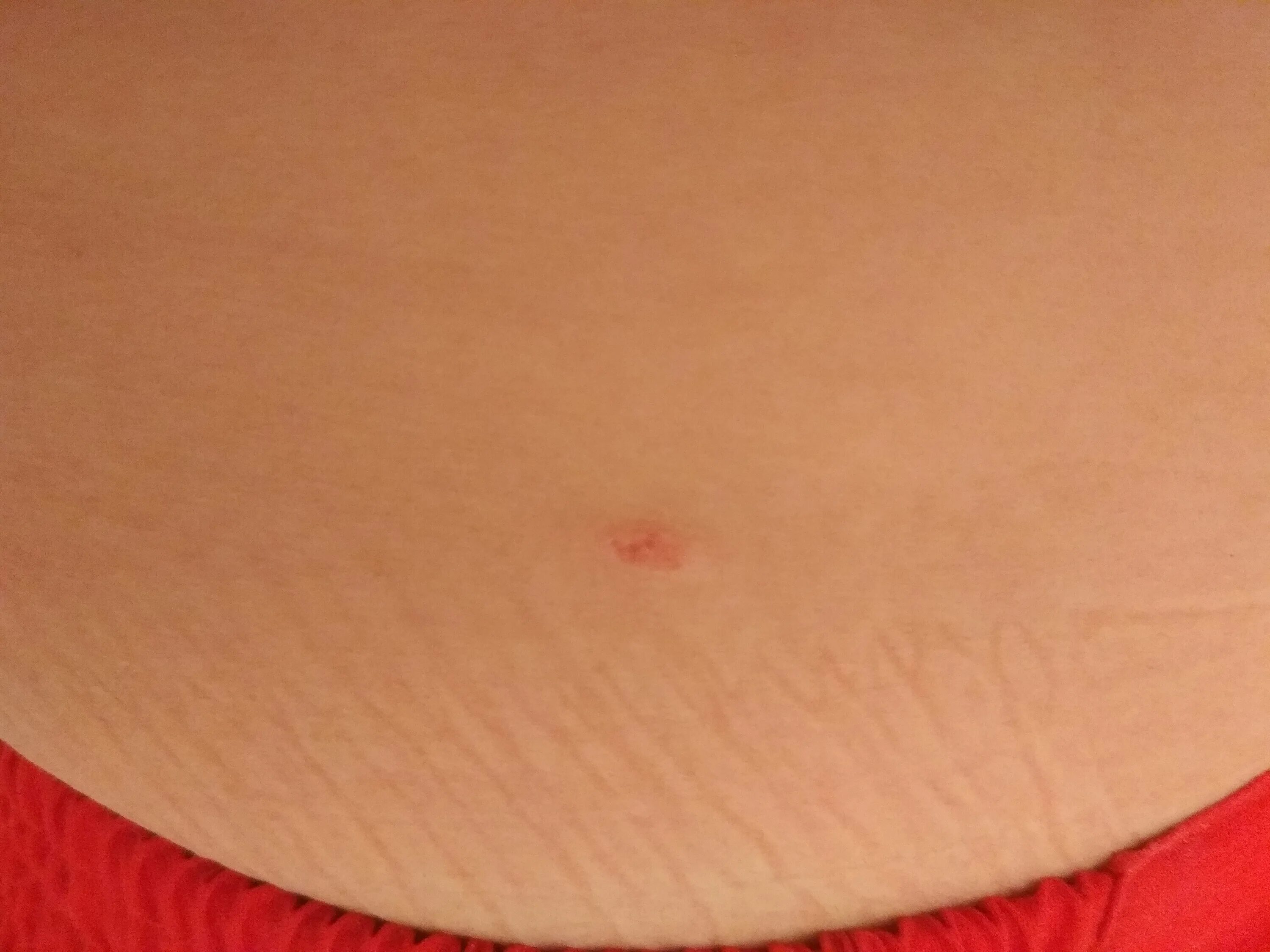 Cherry angioma - Red moles on skin - YouTube