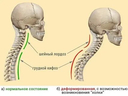 Физиологический лордоз сглажен что это