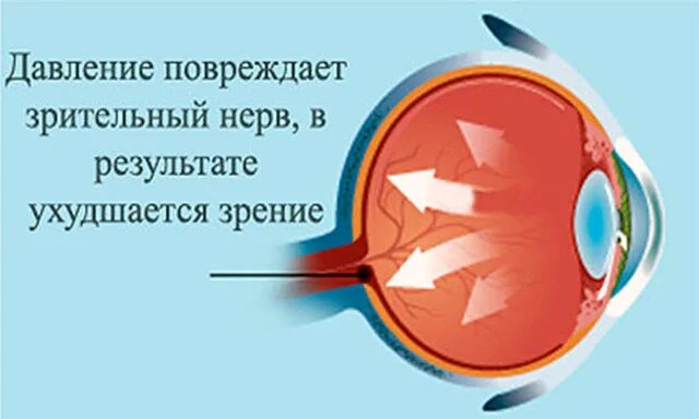 Как проявляется глазное давление симптомы. Повышенное внутриглазное давление симптомы. глазное давление симптомы у взрослых. давление глазного яблока. повышенное давление глазного дна.