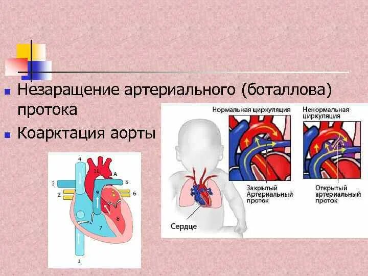 Персистирование боталлова протока. Операции при незаращении боталлова протока. впс баталов проток. заращение боталова протока. незаращение артериального боталлова протока.