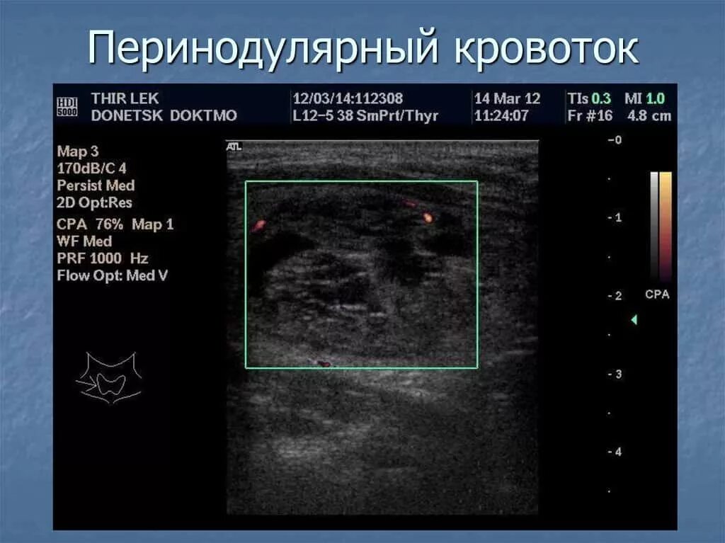 Перинодулярный кровоток что это. Интранодулярный кровоток узла щитовидной. Перинодулярный кровоток узла щитовидной усилен. Типы кровотока в узлах щитовидной железы. Типы васкуляризации щитовидной железы по УЗИ.