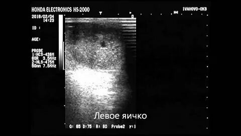 Тяжесть в яичках у мужчин