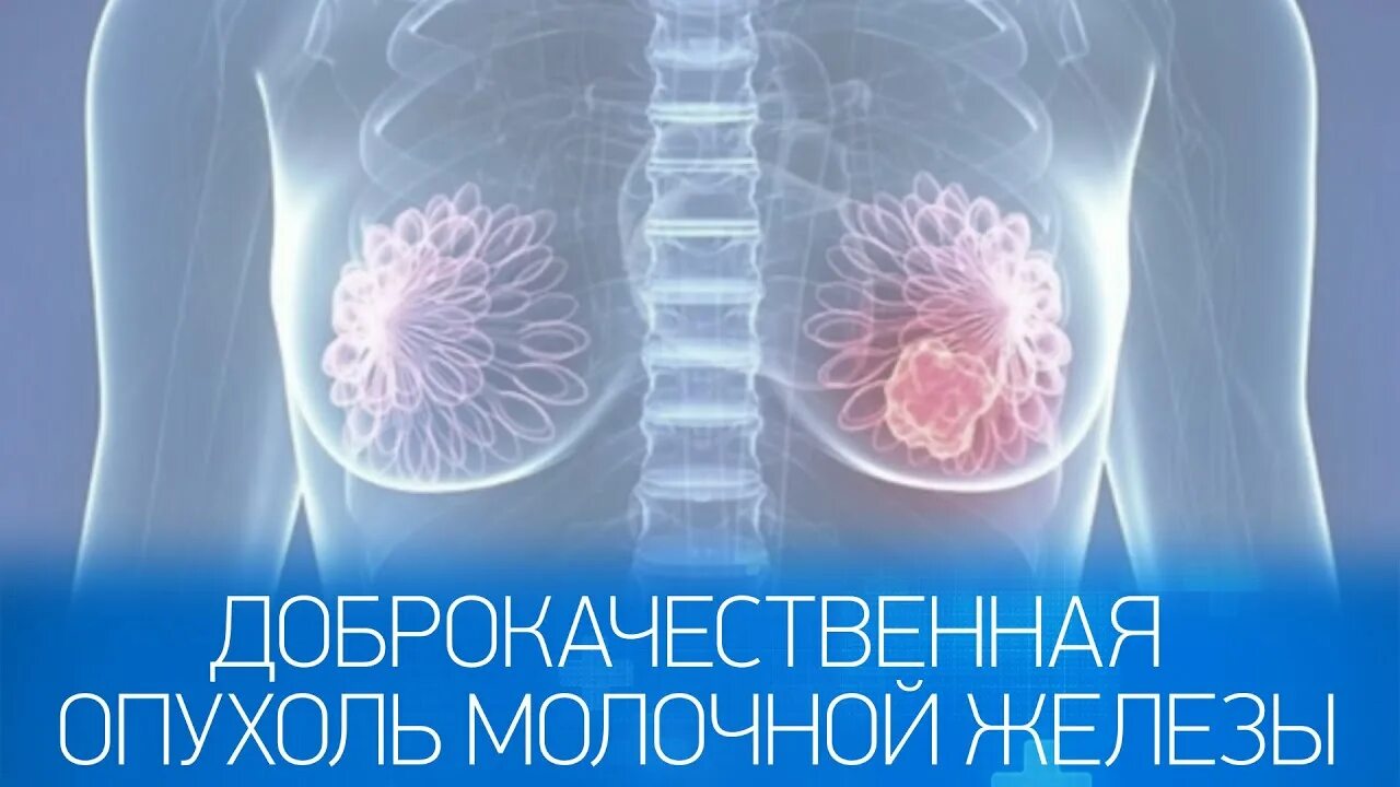 Доброкачественное новообразование молочной железы. Опухоли молочных желез. доброкачественная опухоль груди. новообразование молочной железы. доброкачественная опухоль грудной железы.