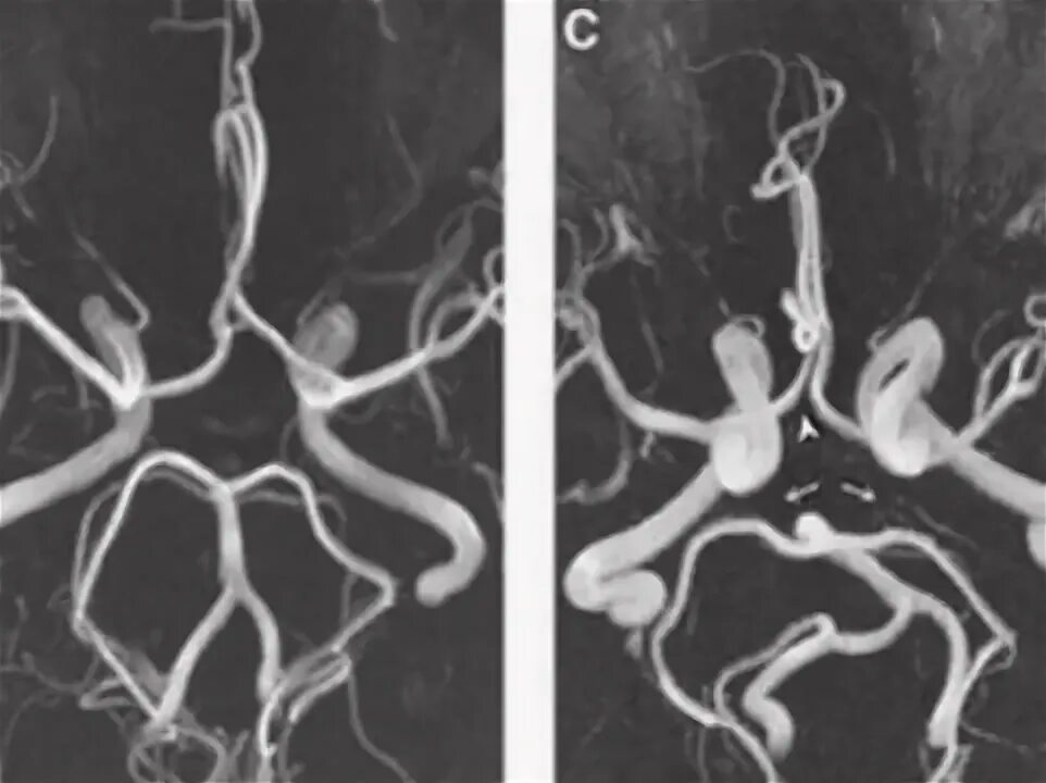Патология Виллизиева круга. Мрт сосудов головного мозга Виллизиев круг. Гипоплазия артерий Виллизиева круга. Аномалии развития Виллизиева круга мрт.