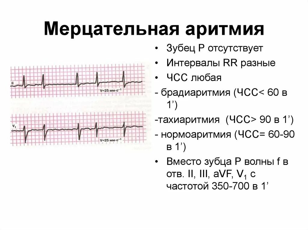 Аритмичные тоны сердца. Признаки мерцательной аритмии на ЭКГ. Синусовая Мерцательная аритмия ЭКГ. Мерцательная аритмия на ЭКГ. Формы мерцательной аритмии на ЭКГ.