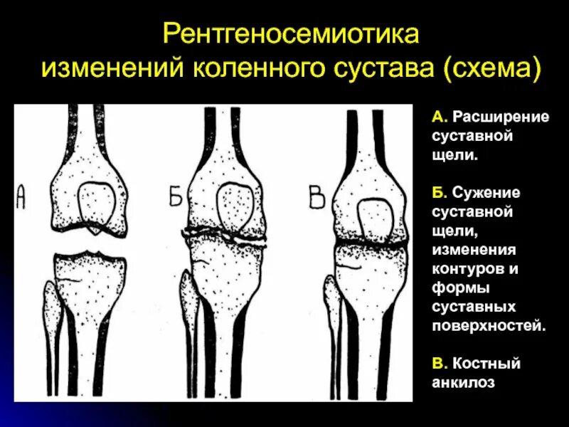 Костный анкилоз коленного сустава. Анкилоз коленного сустава рентген. Сесамовидные кости коленного сустава. Сужение коленных суставов