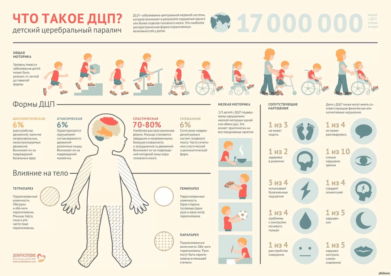 ДЦП В легкой форме симптомы у детей до года. ДЦП У детей симптомы в 1. ДЦП легкая форма симптомы. Лёгкая форма ДЦП признаки у детей. Что такое дцп простыми словами