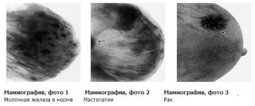На фоне фиброзных изменений. Узловая мастопатия на маммографии. Маммограмма доброкачественных опухолей. Маммография фиброаденома. Маммография опухоль молочной железы.
