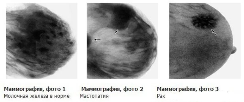 Округлые образования в молочной железе