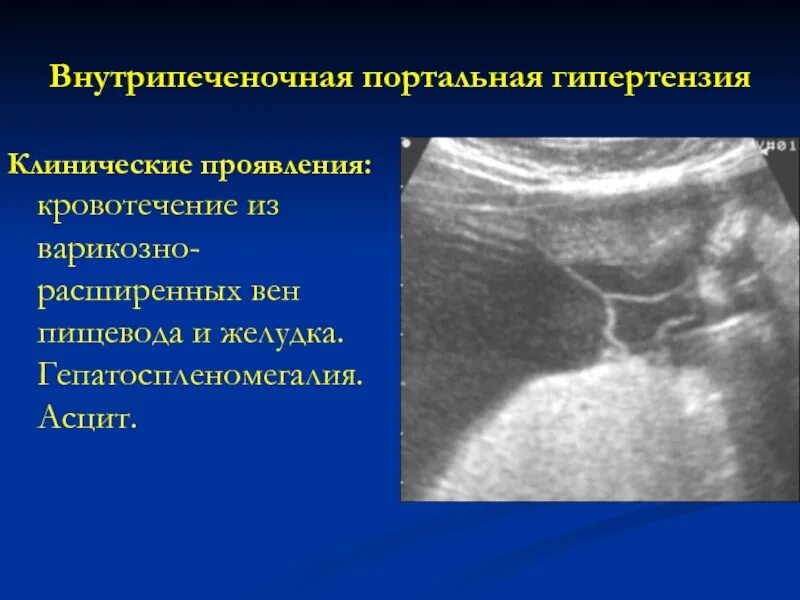 Цирроз печени кровотечение пищевода. Телеангиэктазия портальная гипертензия. Портальная гипертензия внутрипеченочный блок. Пресинусоидальная портальная гипертензия. УЗИ критерии портальной гипертензии.