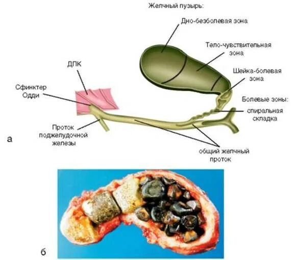 Желчном пузыре что бывает. Трехкамерный желчный пузырь. Желчный пузырь с камнями анатомия. Анатомия человека желчный пузырь камни. Перегиб желчного пузыря анатомия.