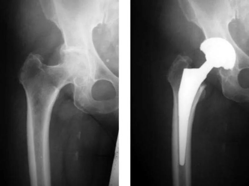 Коксо артроз бедренного сустава. Коксартроз эндопротезирование тазобедренного сустава. Доа тазобедренного сустава рентген. Тотальное эндопротезирование тазобедренного сустава шейки бедра. Замена сустава шейки бедра