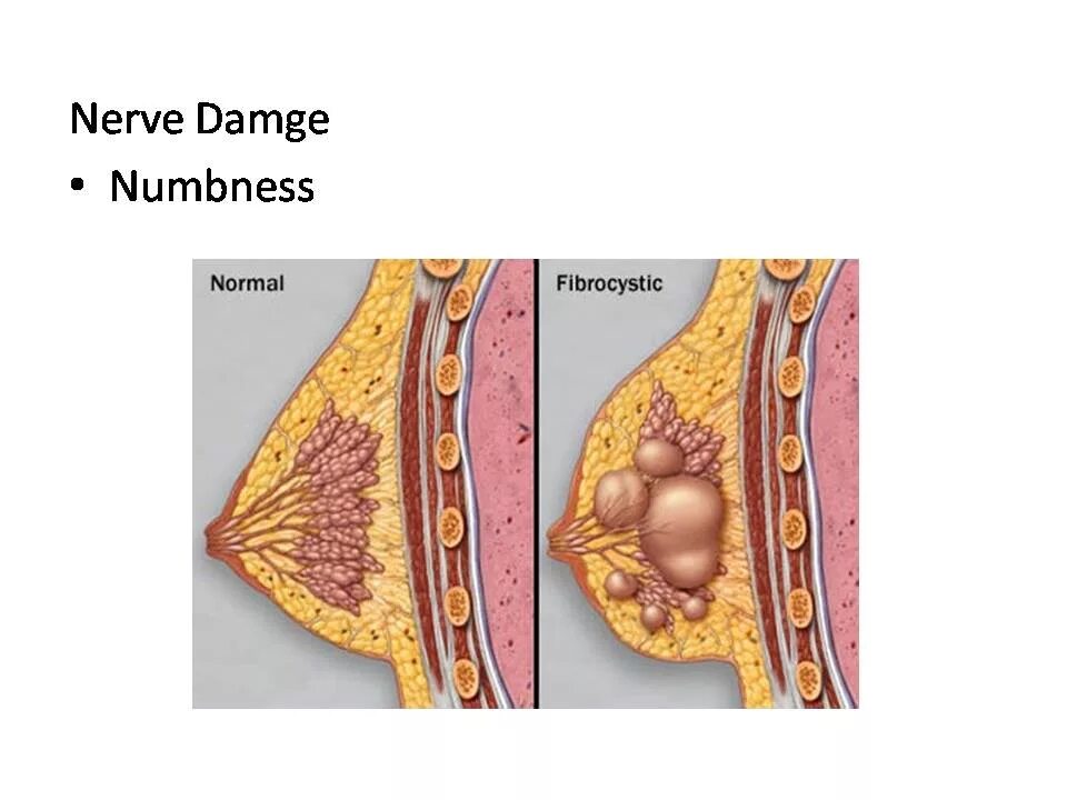 Мастопатия диффузно кистозная мастопатия. Пролиферативная мастопатия молочной железы что это. Фиброзно-кистозная мастопатия молочных желёз. Кожа мастопатии. Диффузная мастопатия молочных желез.