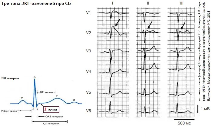 Диффузные изменения экг что это значит. Синдром Бругада ЭКГ критерии. Диагностические ЭКГ критерии синдрома Бругада. Синдром Бругада Тип 2 ЭКГ. Синдром Бругада 1 типа на ЭКГ.