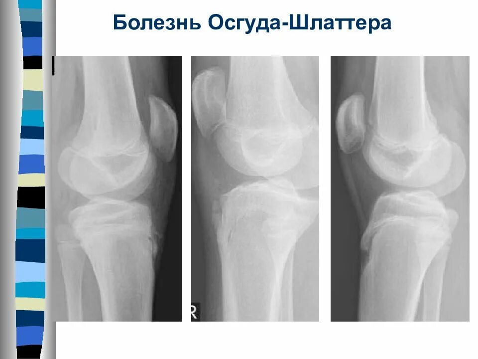 Болезнь осгуда шлаттера код мкб 10. Синдром осгуд шляттера. болезнь осгуд шляттера рентген. болезьнт озгута шлятора. болезнь осгуда-шлаттера рентген.
